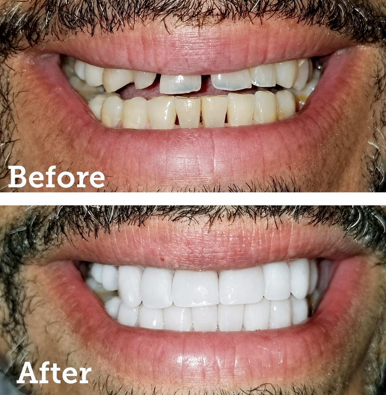 Comparação ilustrativa: sorriso original acima e dentes clareados digitalmente abaixo